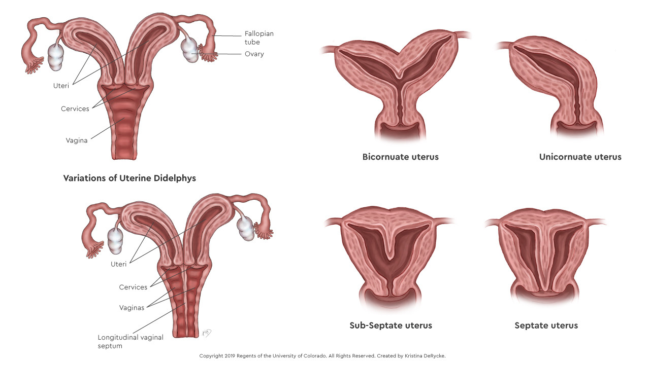Malformasi Kongenital  Organ Reproduksi Wanita